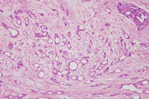 This cancer shows < 75% tubule formation - Tubule score=2